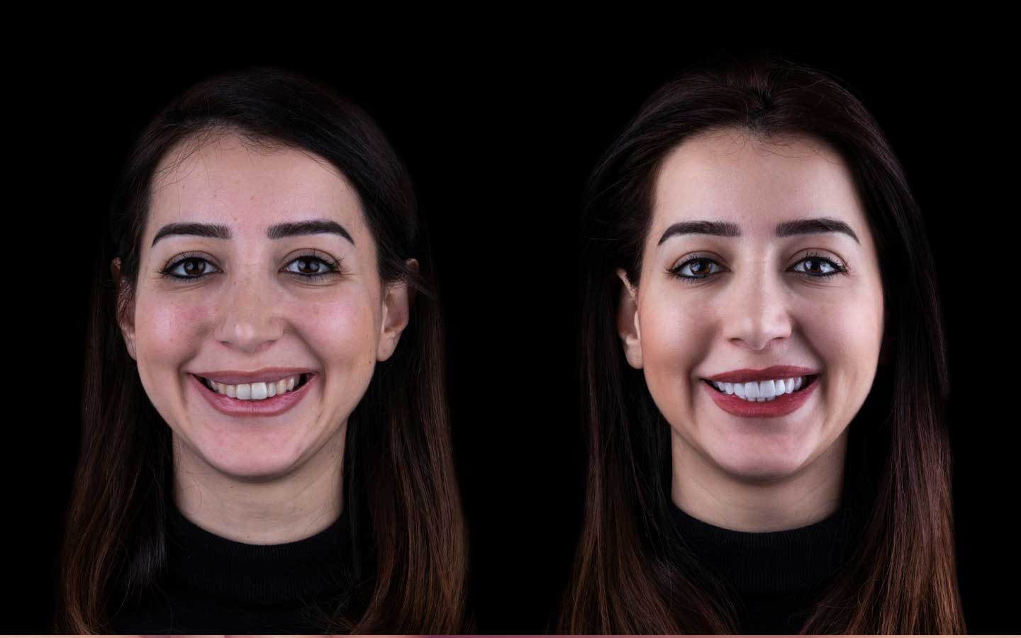 EMAX Diş Kaplama Türkiye