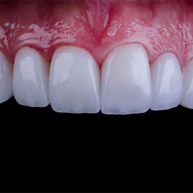 Facettes dentaires emax en Turquie
