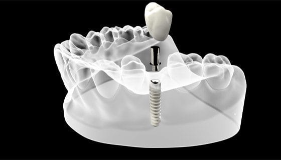 Implant Dentaire Turquie