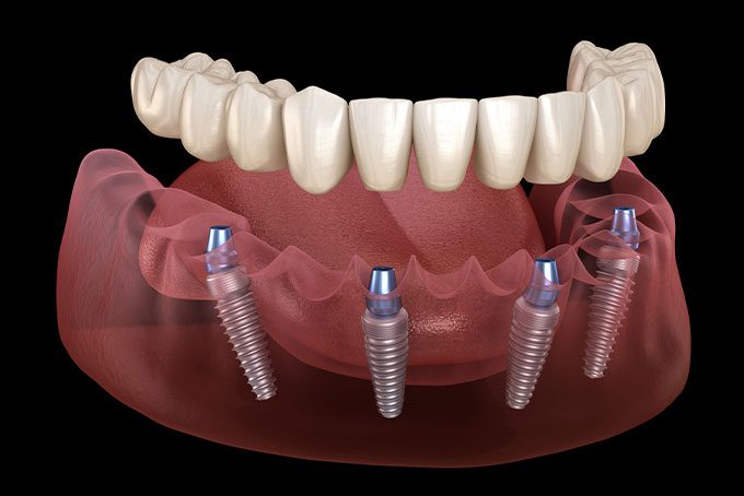 All-on-6 Имплантат