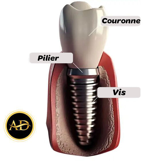 Landing Page FR 1 Implant dentaire en Turquie