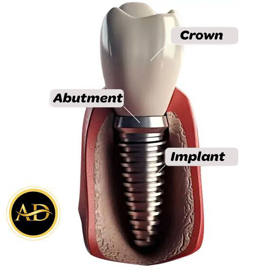 dental implants turkey