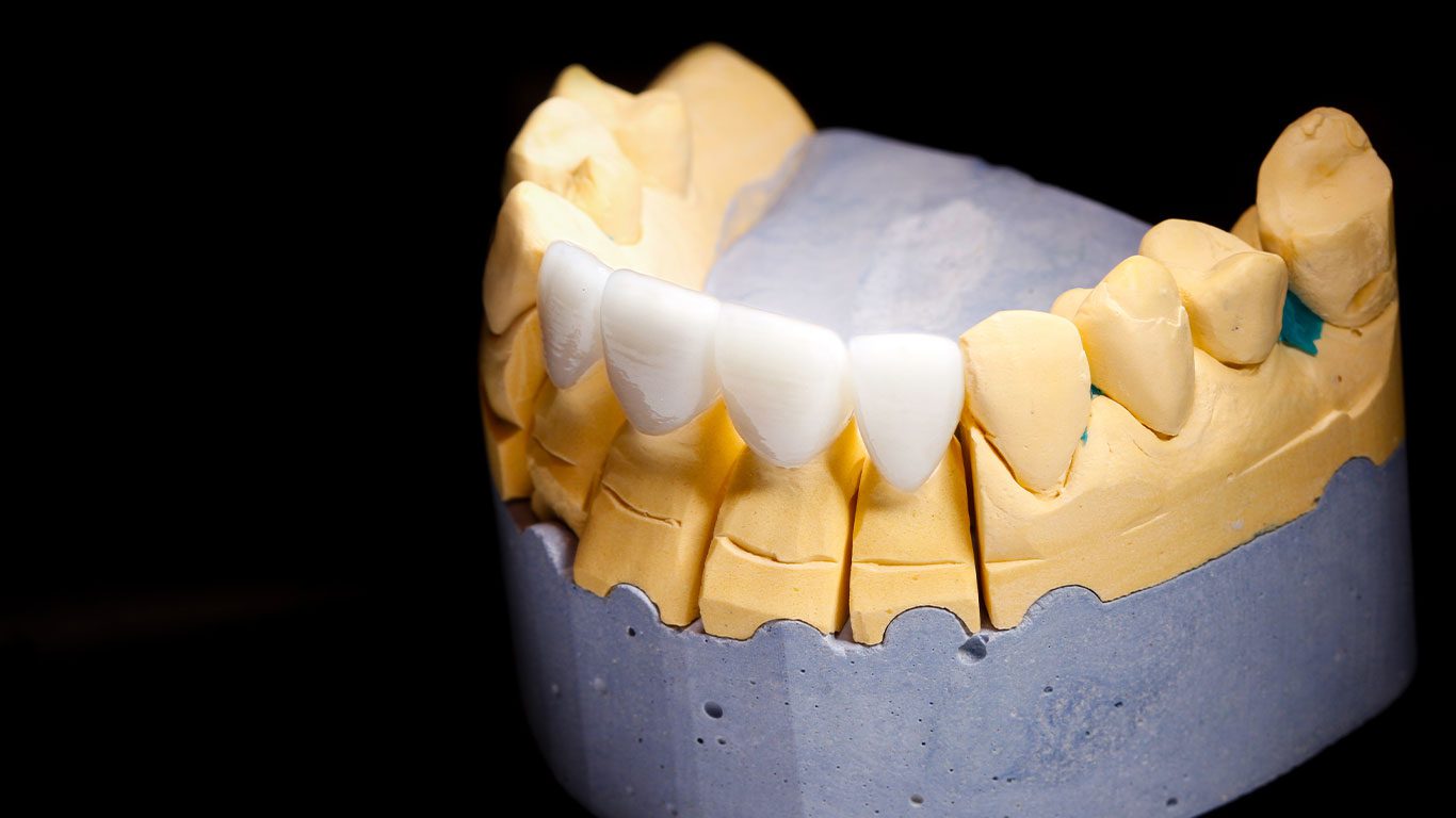 циркониевых коронок 8 Antalya tsirkoniyevoye pokrytiye 2