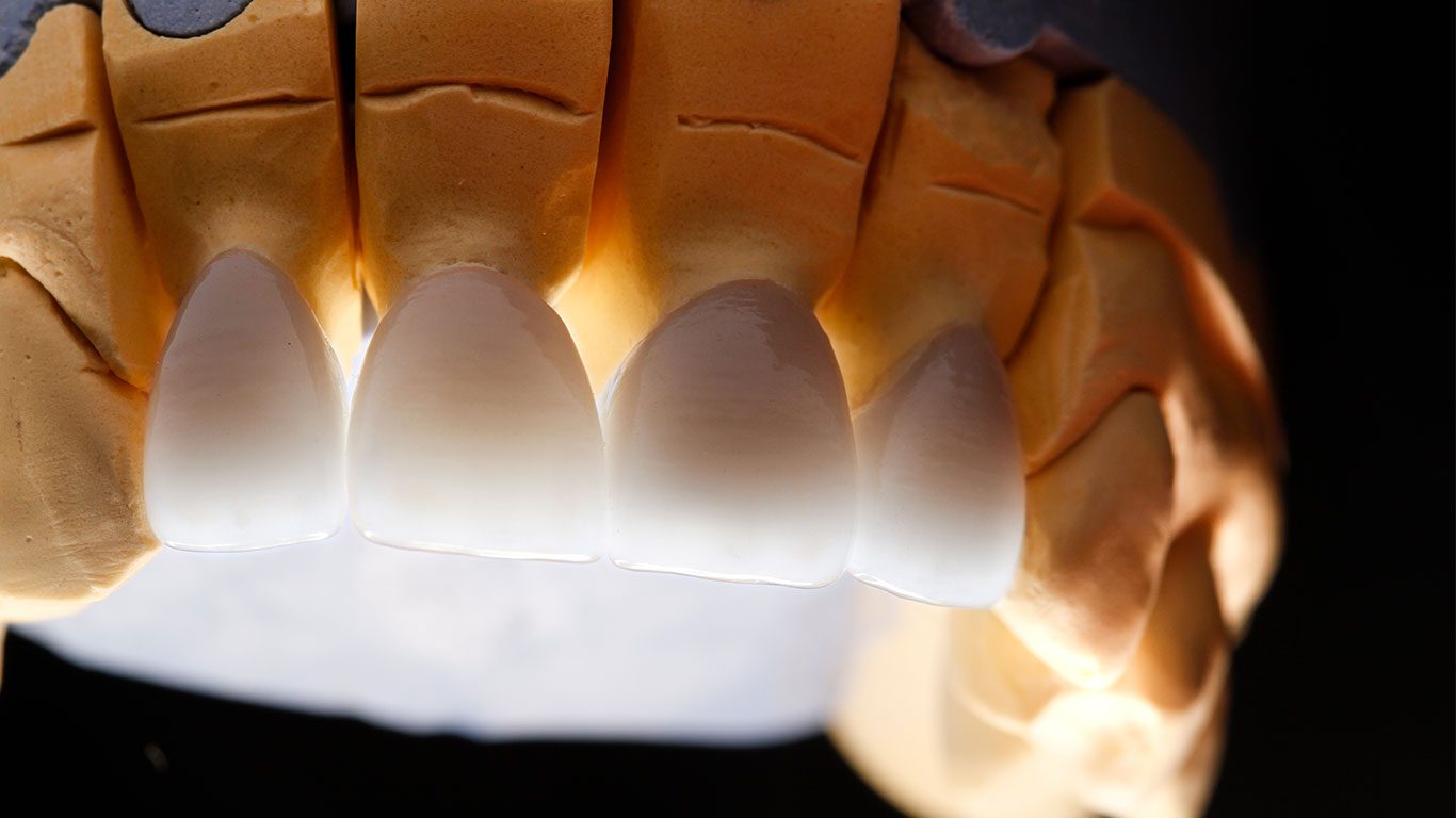 циркониевых коронок 7 Antalya tsirkoniyevoye pokrytiye 3