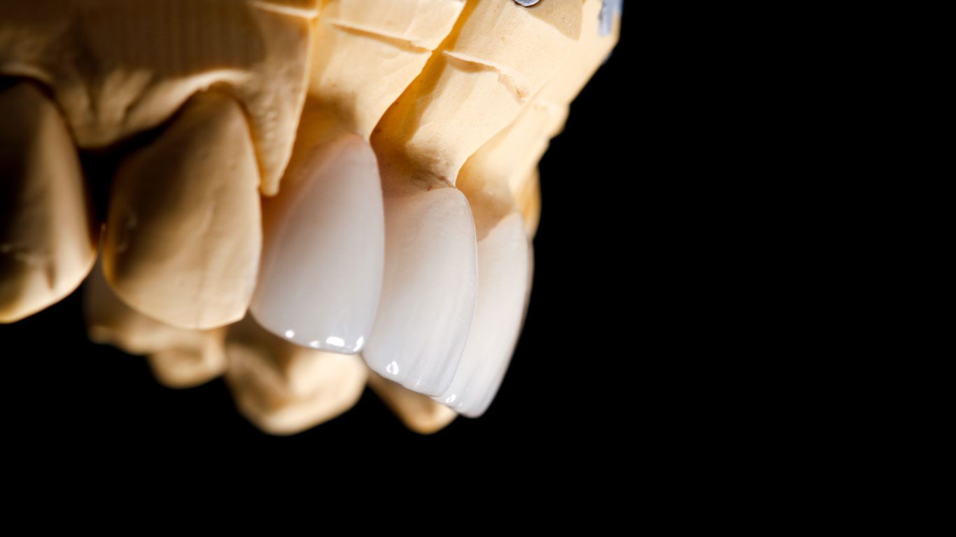 циркониевых коронок 9 Antalya tsirkoniyevoye pokrytiye