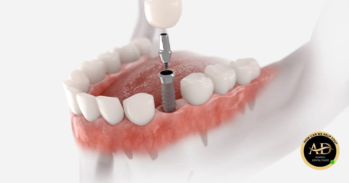 Die besten Marken für Zahnimplantate 1 Image link