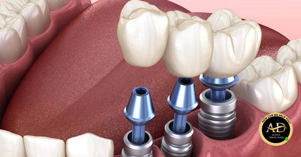Was sind die Durchschnittlichen Preise für Zahnimplantate? 1 Preise für Zahnimplantate