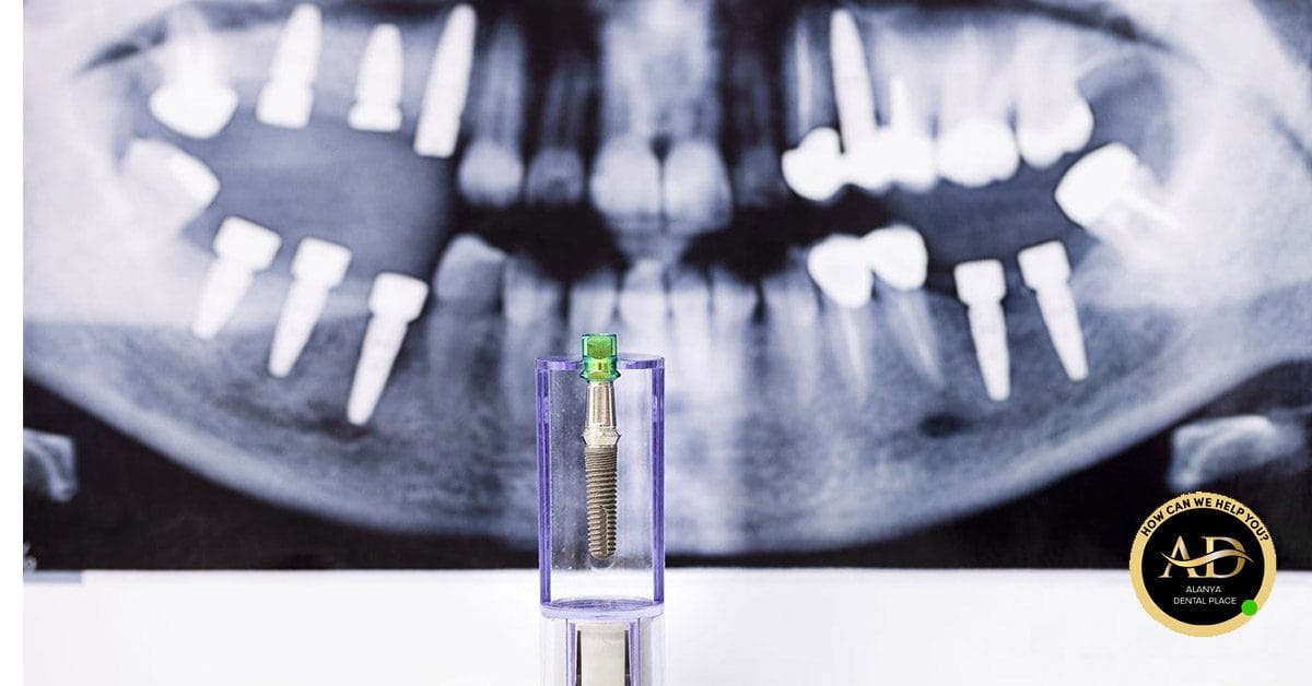 Die besten Marken für Zahnimplantate 3 Schmerzt ein Zahnimplantat?