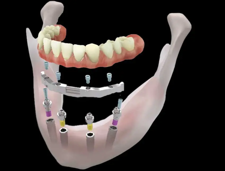 All-on-4/6-Implantation