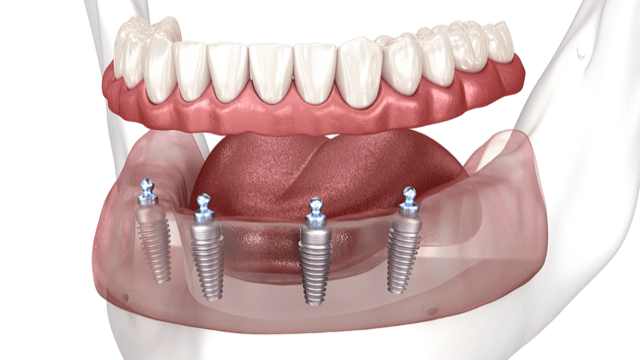 All On 4/6 Implant Treatment in Antalya Turkey