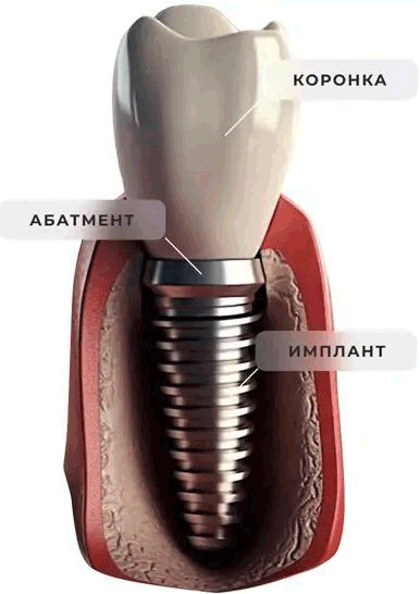 UK Landing 1 Имплантация зубов по доступной цене в Турции