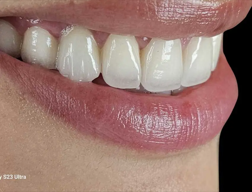 Veneers