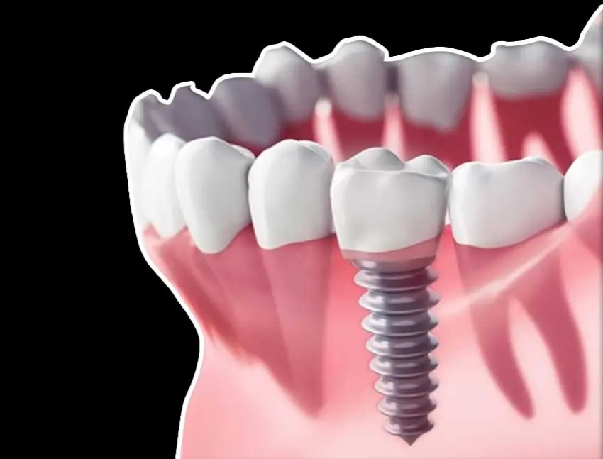 UK Landing 10 Зубні імпланти