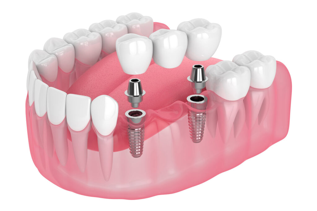 dental implants in turkey