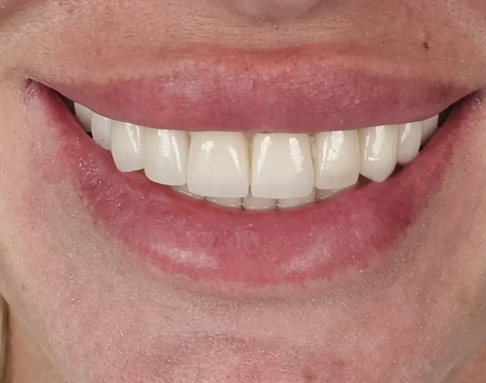 UK Landing 12 Голлівудська посмішка