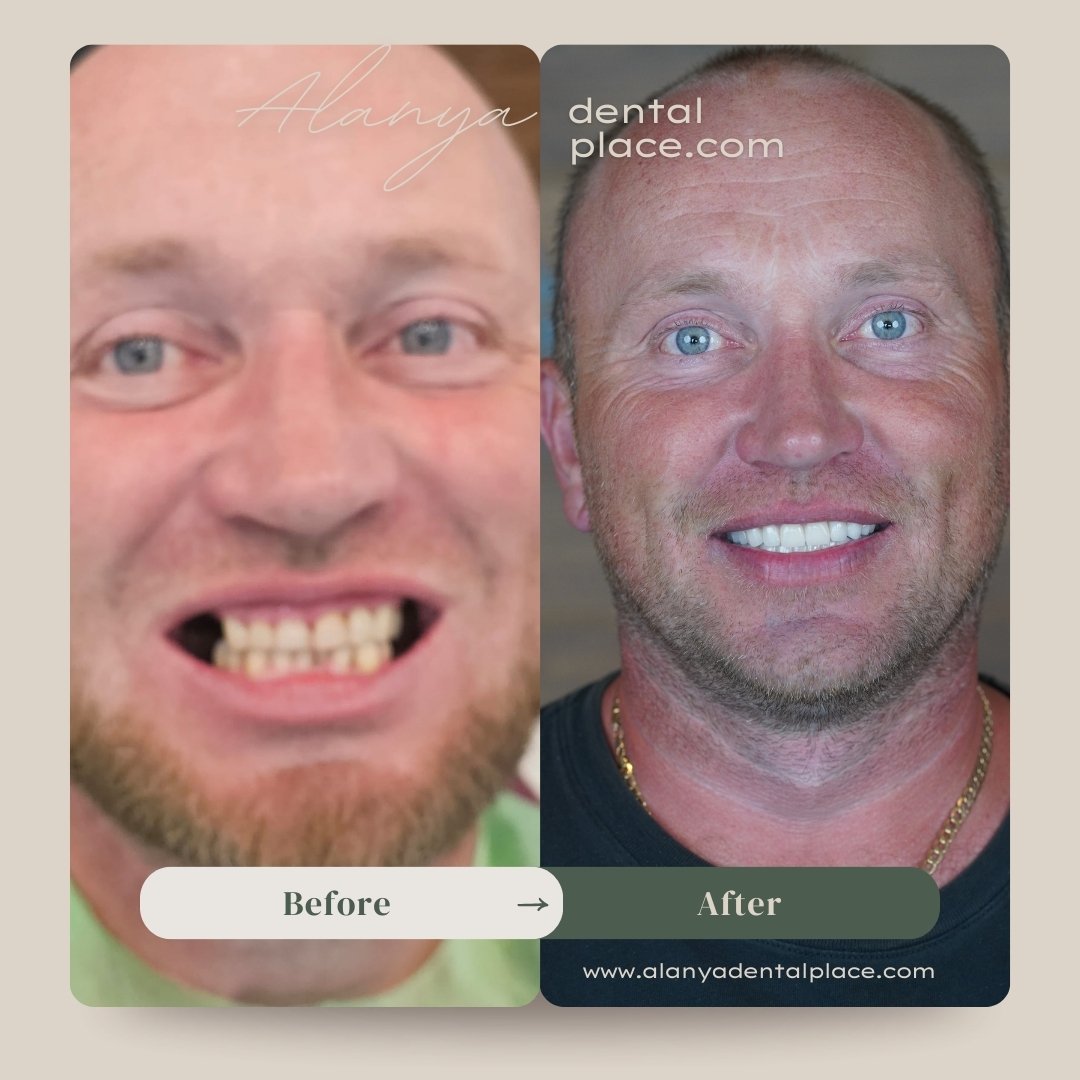 Зубной имплантат Landing 5 before-4.jpg