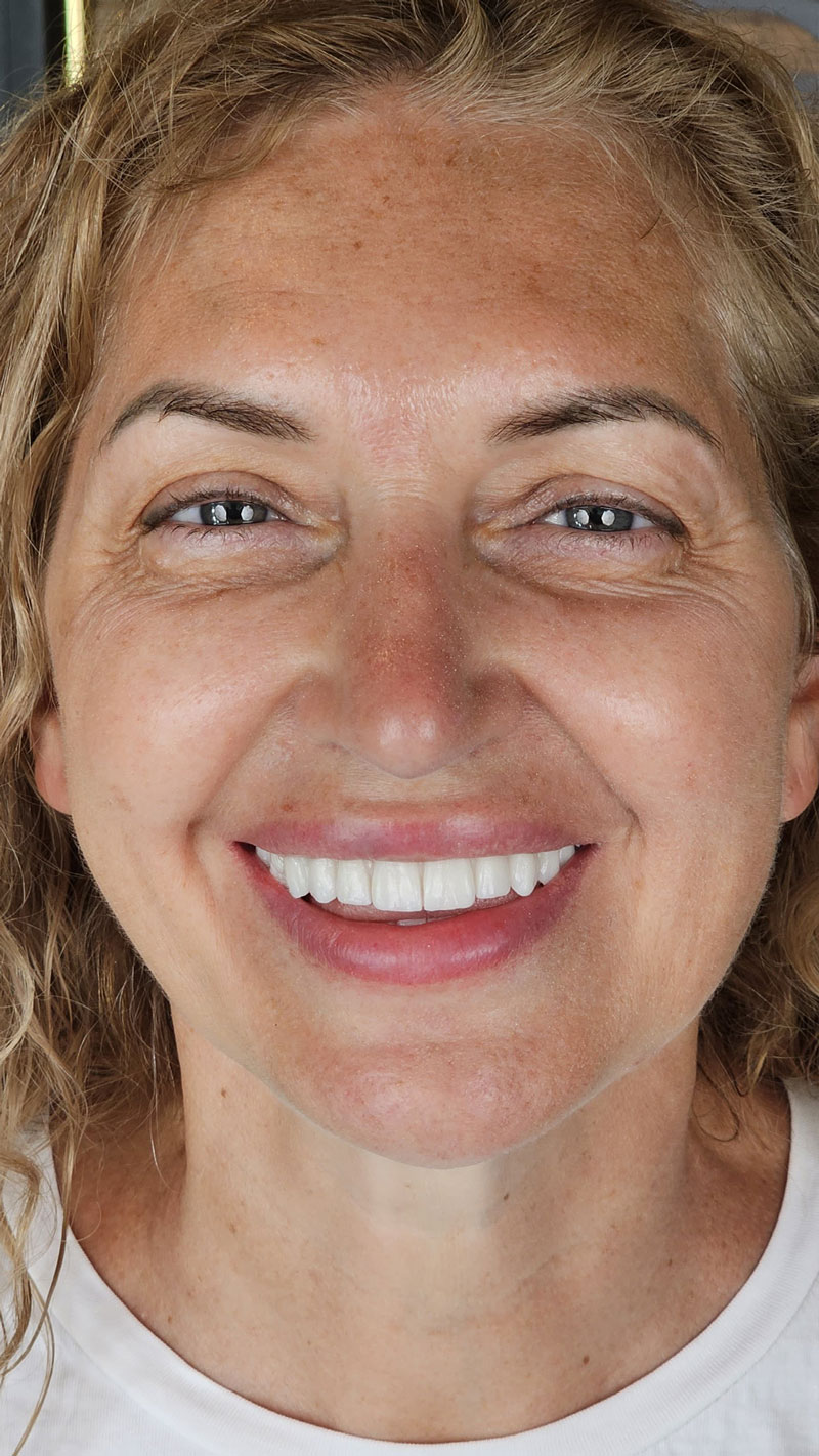 Зубной имплантат Landing 6 Image