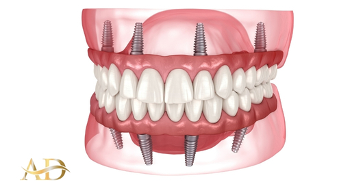 All On 4 Zahnimplantate in der Türkei