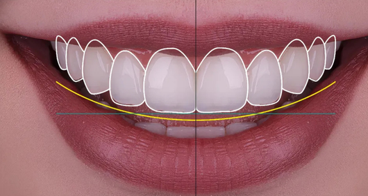 Дизайн улыбки в Анталии