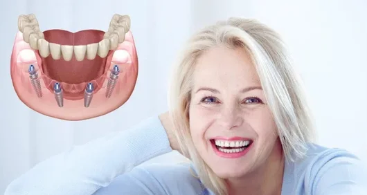 Zahnimplantat in 1 Tag in der Türkei