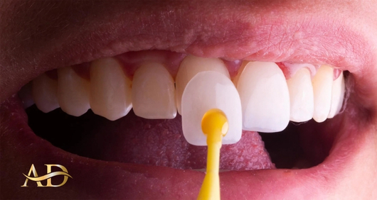 Ламинированная Стоматология 1 Laminirovannaya Stomatologiya v Antal'ya, Turtsiya