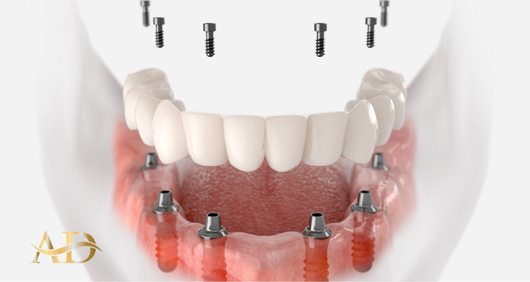 All On Six Implantatbehandlung 1 All On Six Implantatbehandlung Türkei