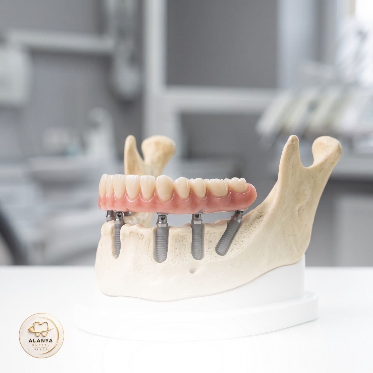 Full Mouth Dental Implants 8 All-on-4 Dental Implants