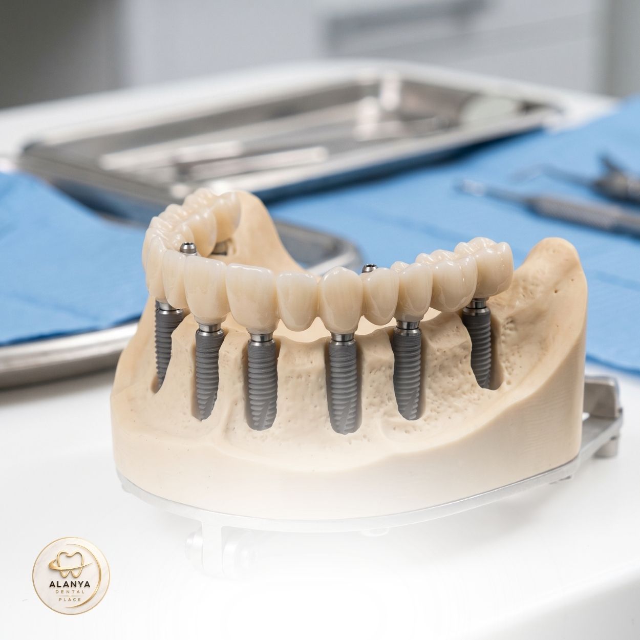 Full Mouth Dental Implants 10 All-on-8 Dental Implants