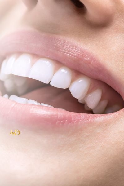 Composite Bonding