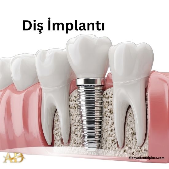 Diş İmplantı