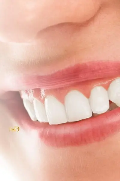 Эстетика десен (Gingival Aesthetics)