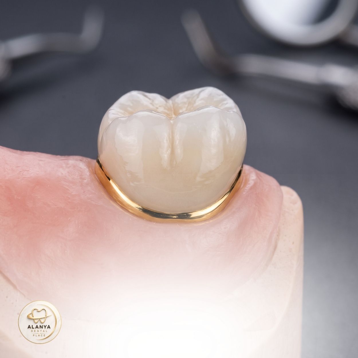 Metal-Supported Porcelain Crowns 5 Gold-Alloy-Reinforced Porcelain