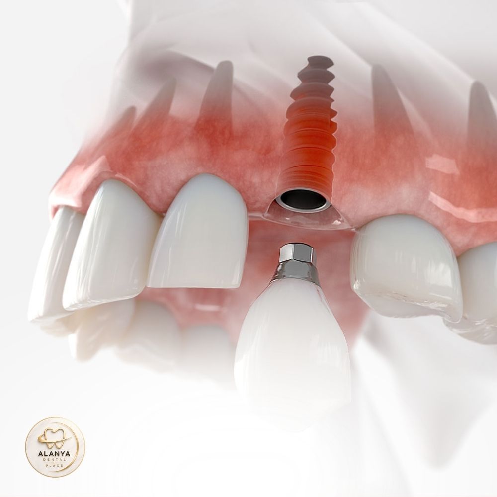 Имплантация зубов 9 Lecheniye zubnoy implantatsii v Turtsii 3