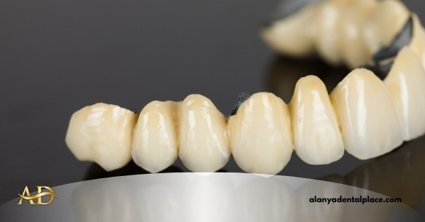 Metal-Supported Porcelain Crowns 1 Image link