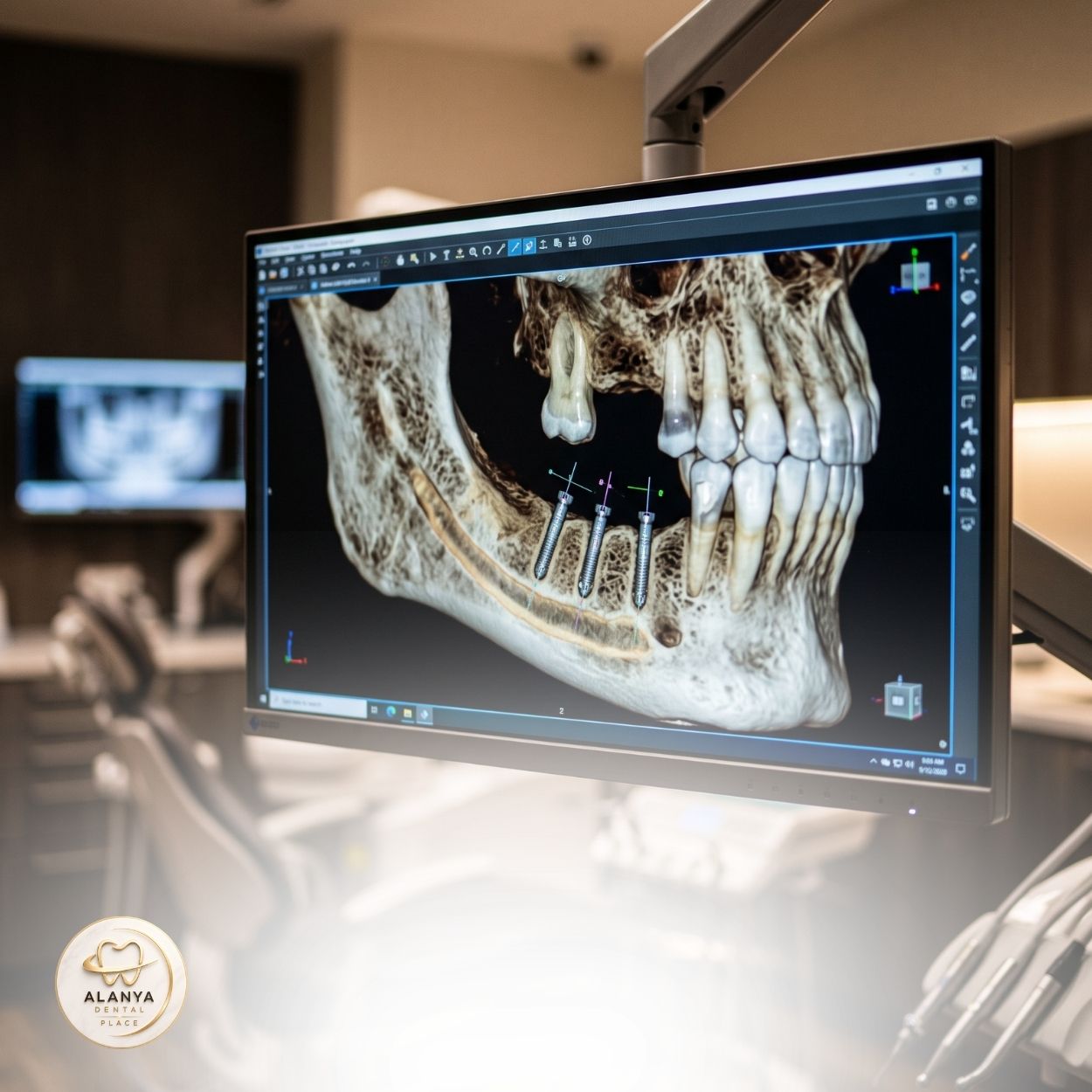 Міні-імплантат зуба 9 Mini implantat zuba 2