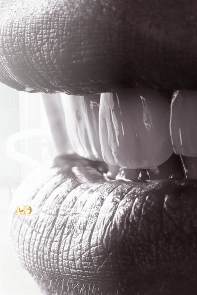 Porcelain Laminate Veneers