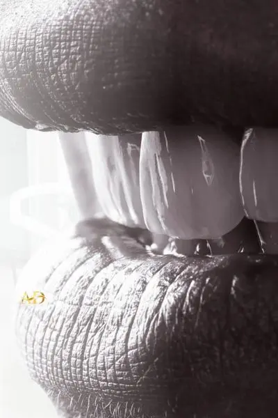 Porzellan-Laminat-Veneers