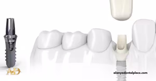 Implantate ohne Schrauben 1 Schraubenlose Zahnimplantate in der Türkei