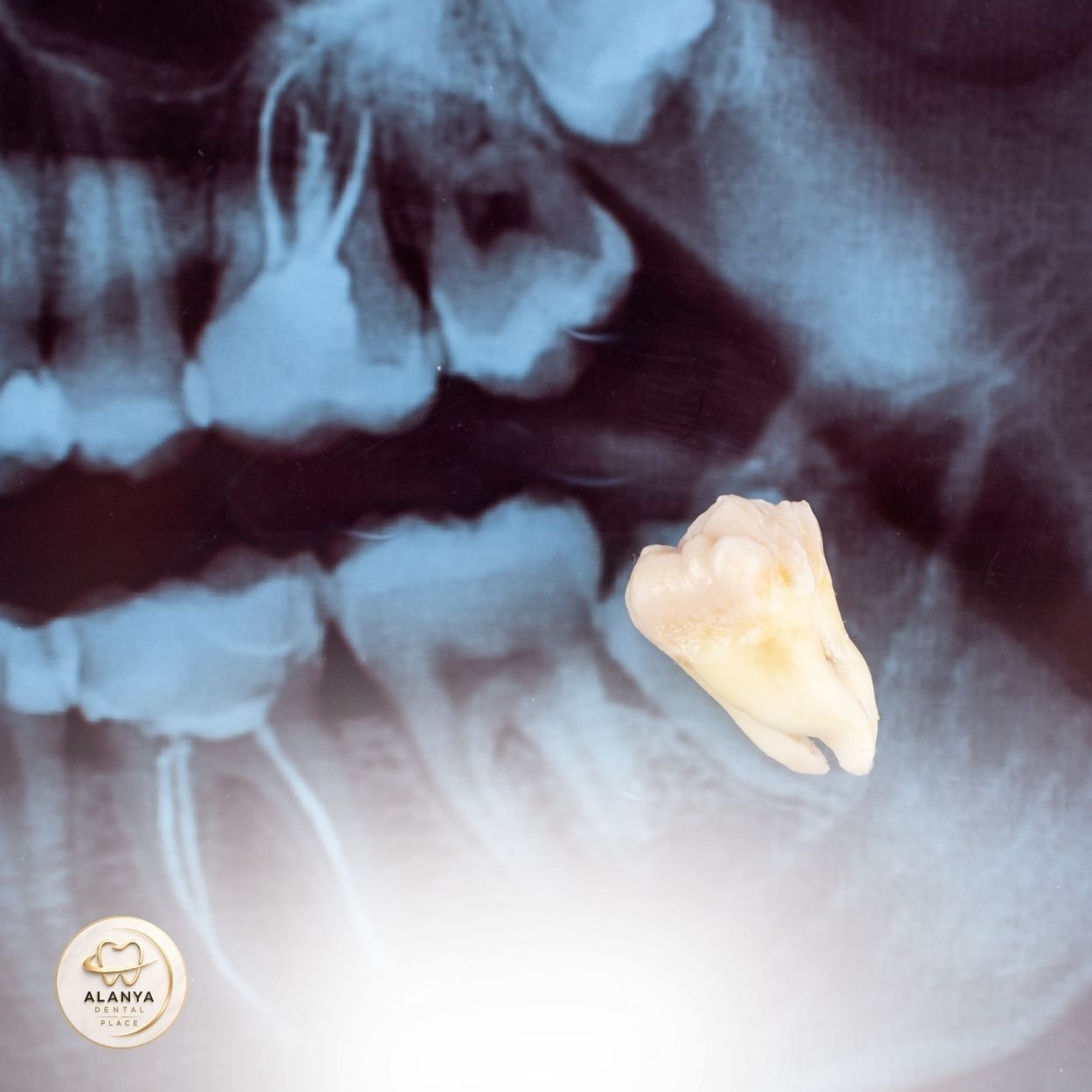 Tooth Extraction 4 Tooth Extraction in Alanya 2