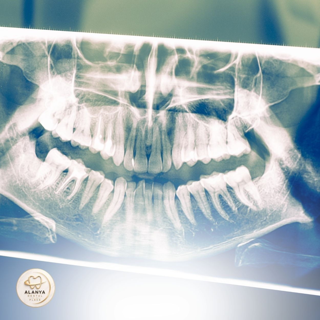 Tooth Extraction 3 Tooth Extraction in Alanya 3