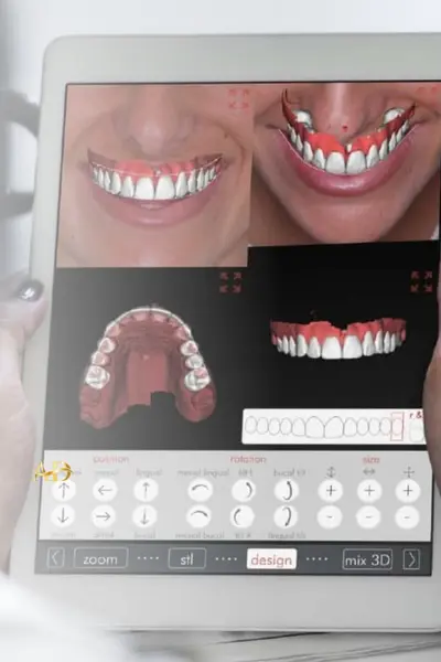 Цифровое проектирование улыбки (Digital Smile Design – DSD)