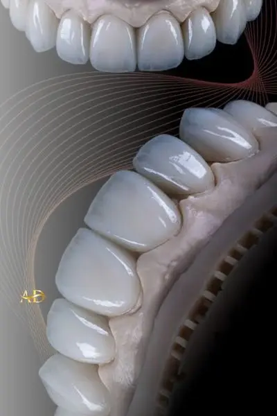 Вініри E-Max (IPS e.max)