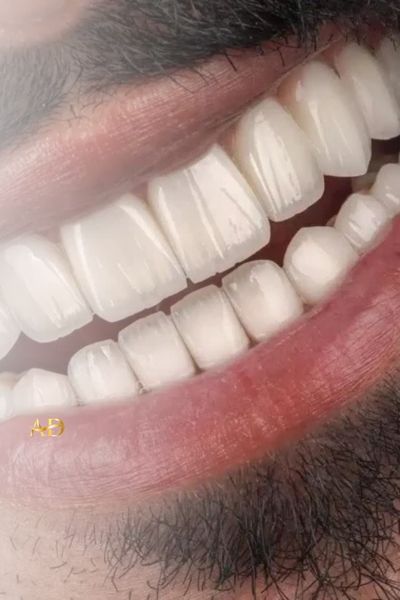 Zirconia Crowns
