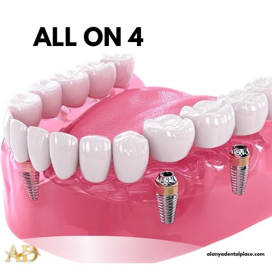Лечение 2 Зубные имплантаты All On 4