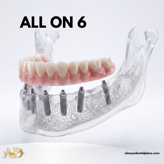 Лечение 3 Зубные имплантаты All On 6