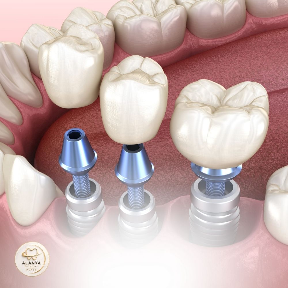Имплантация зубов 10 Zubnyye implantaty v Antalye