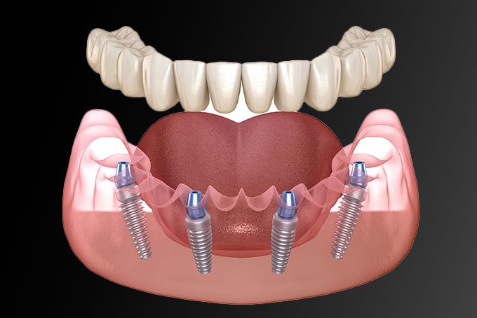  All On 4 Dental Implants
