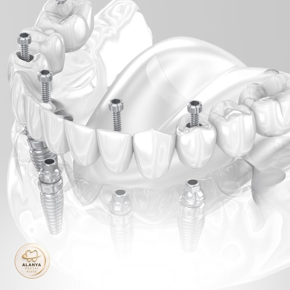 all on 8 diş implantı