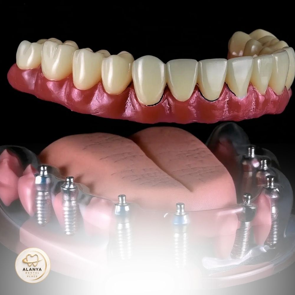 all on 8 diş implantı