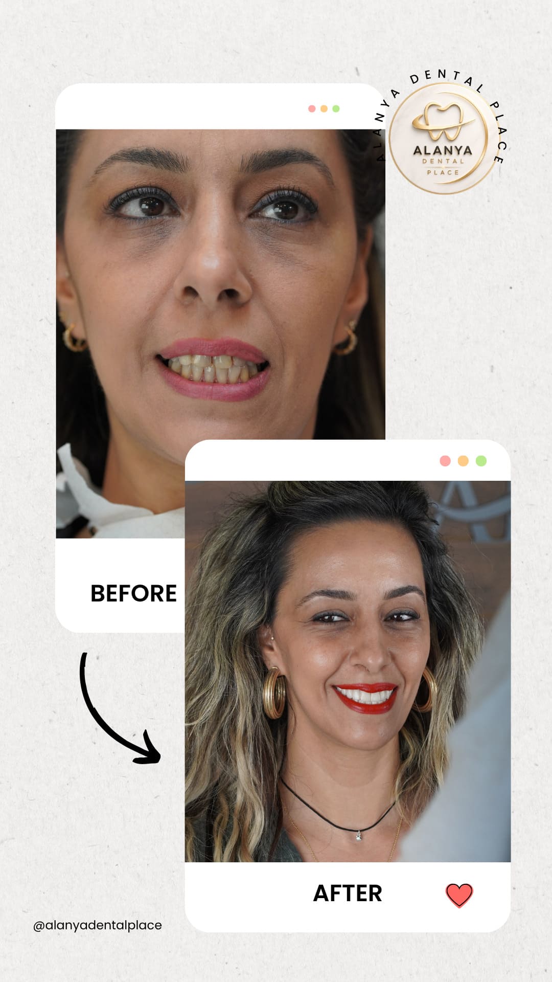 Diş Kaplaması Öncesi Sonrası